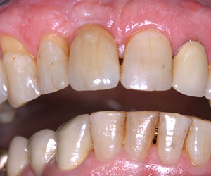 Photographie - Greffe osseuse et couronne sur implant