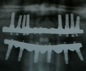 Radiographie - 2 bridges complets sur implants